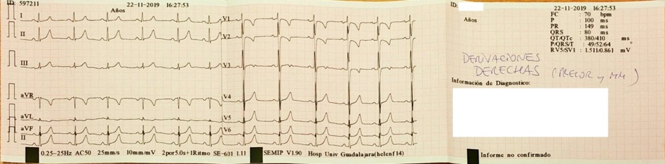 ECG con electrodos en espejo, normal