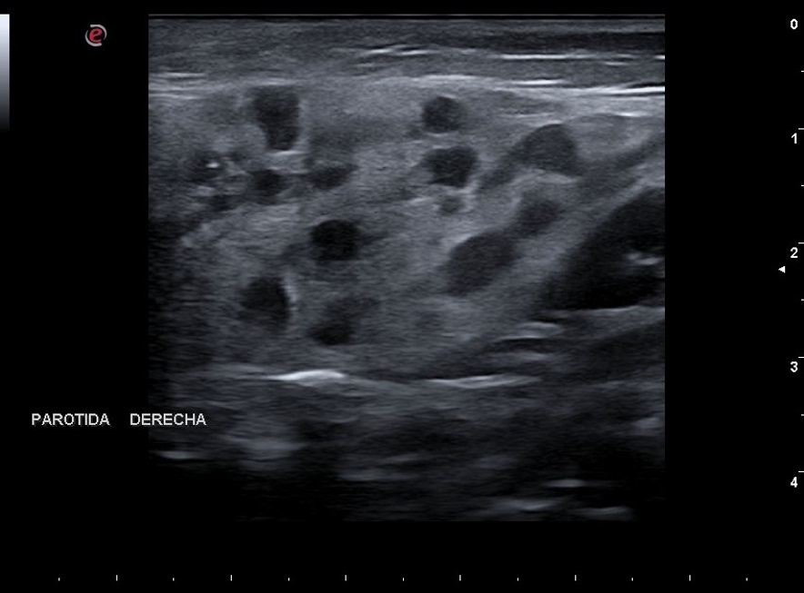 Figura 1. Ecografía parotídea derecha. Múltiples imágenes quísticas con adenopatías regionales 