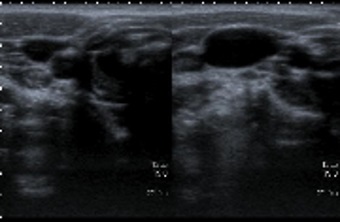 Figura 1. Ecografía antes y después de hacer soplar al paciente.