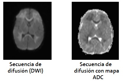 Se identifica afectación difusa de la sustancia blanca periventricular, cuerpo calloso y cápsula interna, con presencia de restricción del agua libre en el estudio de difusión con caída de la señal en el mapa ADC. Hallazgos compatibles con leucoencefalitis