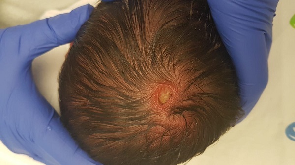 Figura 1. Imagen de la lesión por aplasia cutis congénita.