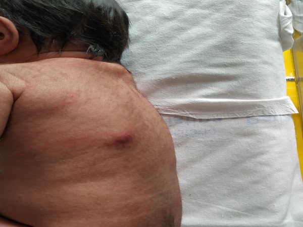 Figura 1. Nódulo indurado eritematoso en la región dorsal izquierda