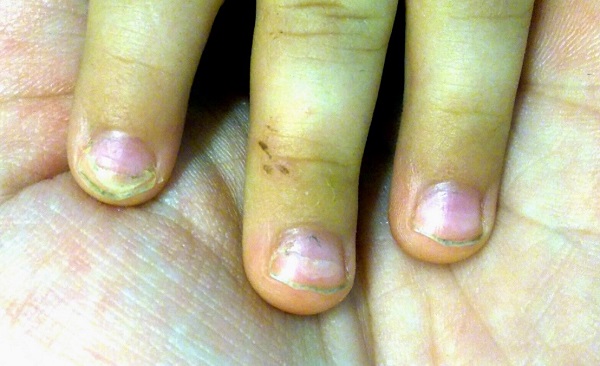 Figura 1. Distrofia ungueal