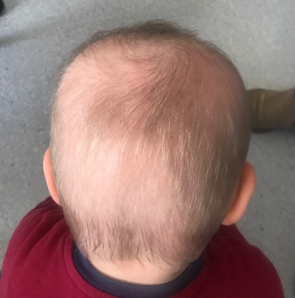 Figura 1. Cabello ralo y escaso