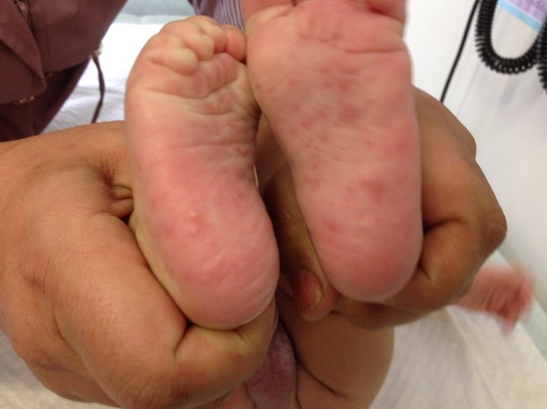 Figura 1. Vesículas en las plantas de los pies