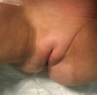 Figura 2. Seis meses después, lesiones acrómicas cutáneas más expandidas