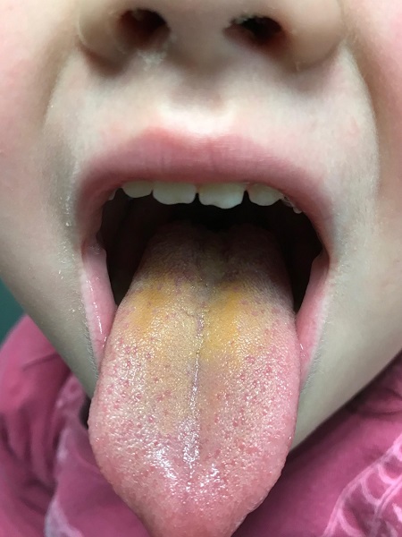 Figura 1. Lengua con coloración amarillenta