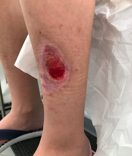 Figura 1. Lesión por el reto de la ballena azul