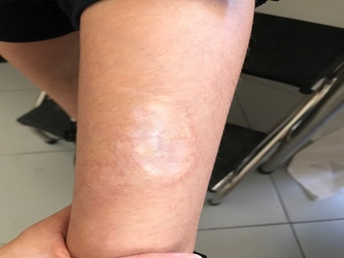 Figura 2. Cicatriz un año después