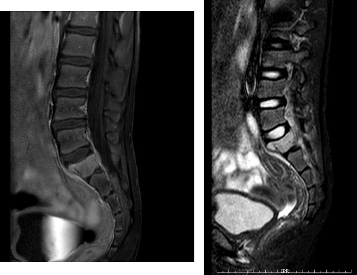 Figura 1. Diferentes secuencias de RM lumbar y sacro-iliaca. Se identifica lesión lítica expansiva en ala sacra derecha y cuerpo de S1, asociando pequeña masa de partes blandas y disminución de la altura/aplastamiento del cuerpo de S1 con hundimiento de la cortical superior con disco intervertebral L5-S1 ensanchado, ocupando la depresión ósea