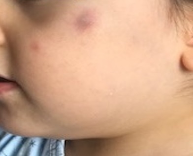 Figura 1. Nódulo facial en un niño de tres años