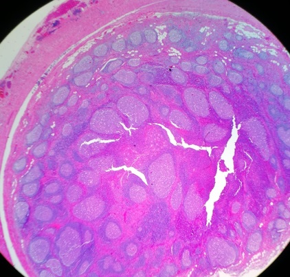 Figura 2. Anatomía patológica de apéndice cecal. Imagen histológica (10×, tinción hematoxilina-eosina) de la mucosa, pared y tejido adiposo subseroso, del apéndice, con presencia en todas ellas de folículos linfoides reactivos con centros germinales de morfología heterogénea