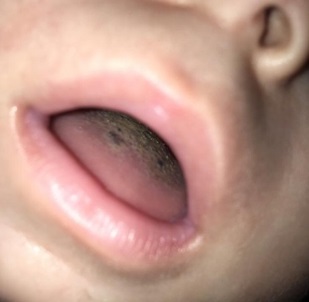 Figura 1. Lengua vellosa negra en lactante; presentación inicial
