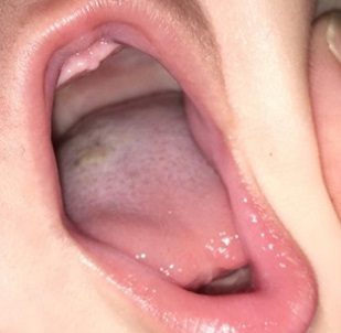 Figura 2. Lengua vellosa negra en lactante; tras 1 semana de tratamiento