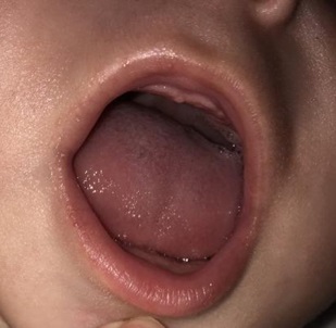 Figura 3. Lengua vellosa negra en lactante; a los 10 días de comienzo del tratamiento