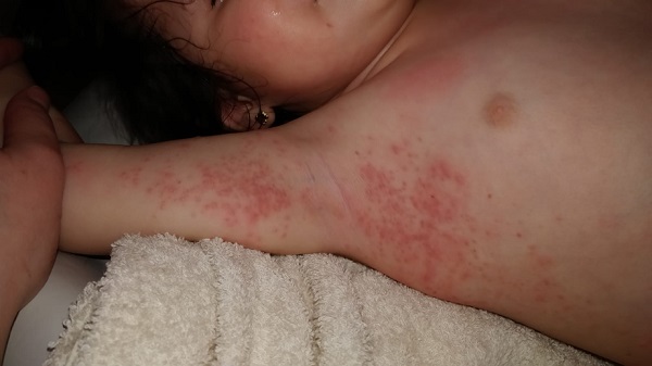 Figura 1. Lesiones maculopapulosas eritematosas en el pliegue axilar, el hemitórax y el brazo derecho