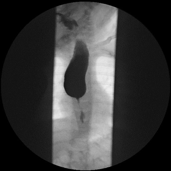 Figura 2. Dilatación esofágica en el tercio superior. Estenosis esofágica medio-distal con escaso paso del contraste