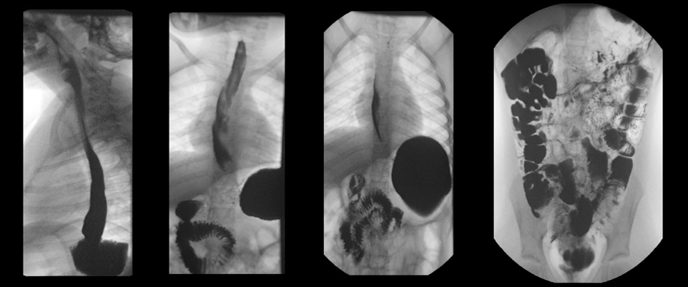 Figura 2. Tránsito baritado que muestra distensión e hipomotilidad gástrica con paso rápido de contraste a duodeno, sin datos de obstrucción a ningún nivel 