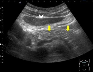 Ecografía abdominal. Corte transversal de la región epigástrica. Se aprecia hiperecogenicidad difusa del parénquima pancreático (flechas amarillas) con respecto al parénquima hepático (rotulado como una cabeza de flecha)