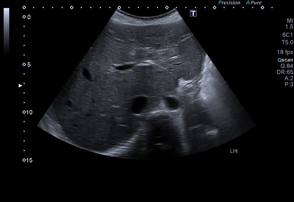 Ecogenicidad hepática heterogénea con áreas hiperecogénicas
