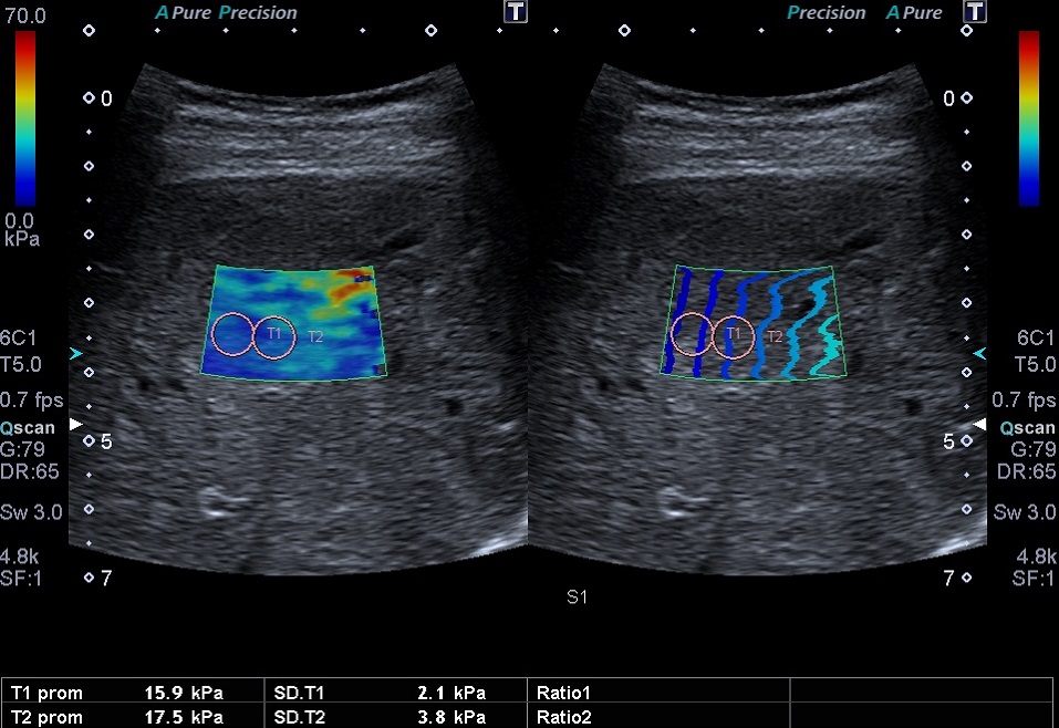 Elastografía. Valores elevados con respecto al valor normal para edad y sexo
