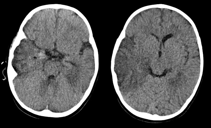 Figura 1. Tomografía computarizada craneal sin contraste. Cortes axiales. Extensa hipodensidad temporoparietal derecha, con discreto efecto de masa sobre sistema ventricular derecho y leve desplazamiento de la línea media. Pequeños focos hiperdensos en la punta del temporal derechos, sugestivos de focos hemorrágicos. Hipodensidad temporobasal izquierda sin efecto de masa significativo