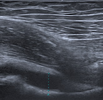 Figura 1. Ecografía de partes blandas: se aprecia líquido articular en la cadera derecha