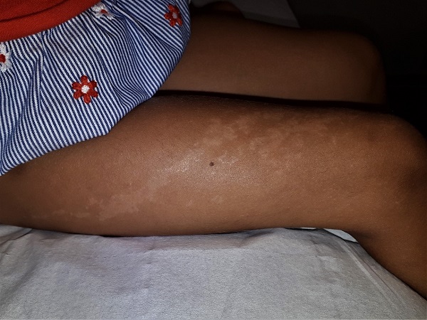 Figura 1. Liquen estriado en la extremidad inferior