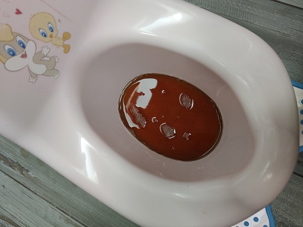 Figura 1. Orina color rojo oscuro recién depositada en orinal 