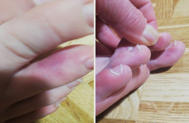 Figuras 1 y 2. Acroisquemia por COVID-19. Caso 1, varón de 12 años, día 1