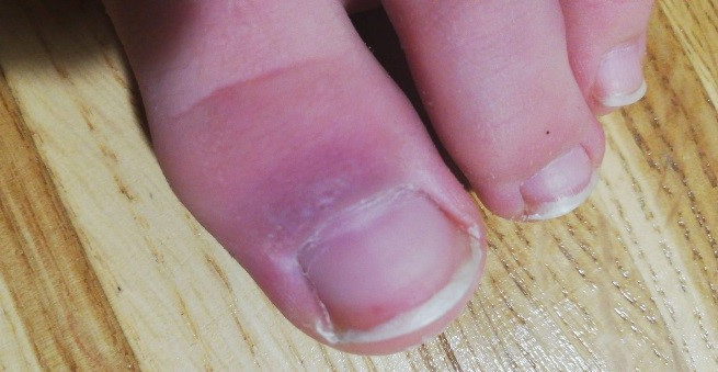 Figura 3. Acroisquemia por COVID-19. Caso 1, varón de 12 años, día 1