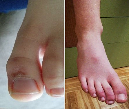 Figuras 6 y 7. Acroisquemia por COVID-19. Caso 2, varón de 12 años, día 1