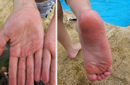 Figuras 6 y 7. Acroisquemia por COVID-19. Caso 2, varón de 12 años, día 1