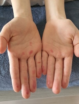 Figura 8. Acroisquemia por COVID-19. Caso 2, varón de 12 años, día 2