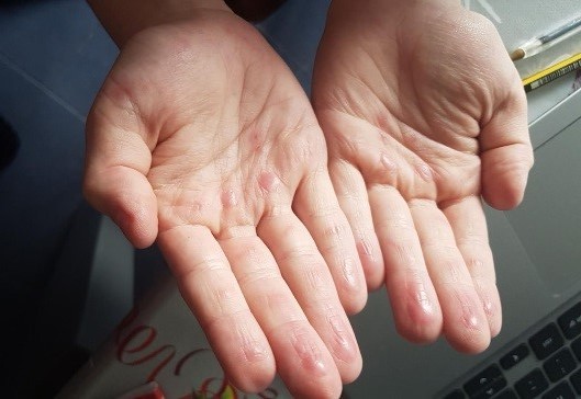 Figura 9. Acroisquemia por COVID-19. Caso 2, varón de 12 años, día 7