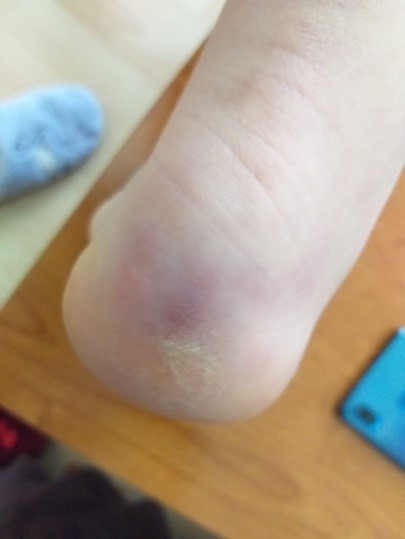 Figura 10. Acroisquemia por COVID-19. Caso 3, mujer de 18 años, día 1