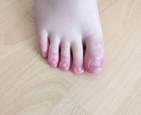 Figura 11. Acroisquemia por COVID-19. Caso 3, mujer de 18 años, día 21