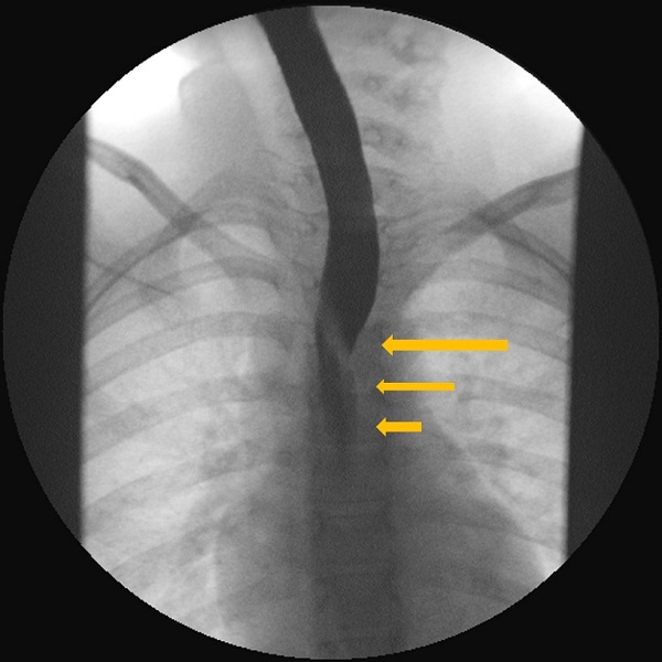 Figura 2. Estudio esófago-gastroduodenal con contraste baritado. Proyección anteroposterior. Se observa la impronta oblicua de la arteria subclavia derecha aberrante (ARSA) en el tercio medio esofágico y la ralentización del flujo del contraste baritado a su través