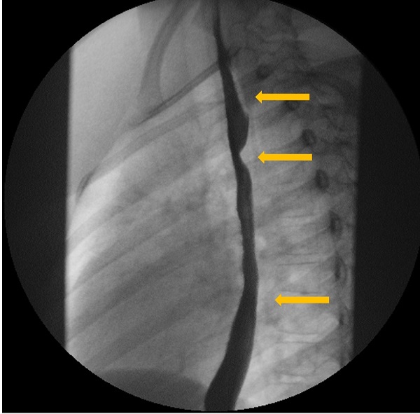Figura 3. Estudio esófago-gastroduodenal con contraste baritado. Proyección lateral. Se identifica la indentación en la pared posterior del tercio medio del esófago