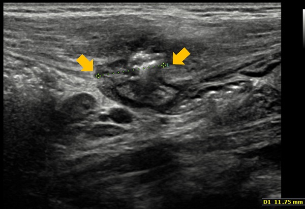 Figura 1. Ecografía en la que se observa hernia en la pared abdominal derecha con contenido de asas intestinales y grasa mesentérica, con un eje mayor de 29 mm y un orificio de 12 mm