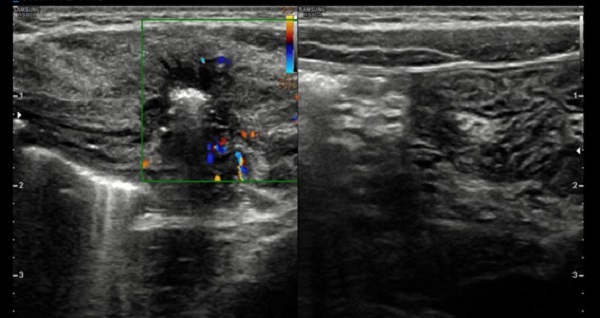 Figura 2. Ecografía Doppler para identificación de estructuras vasculares