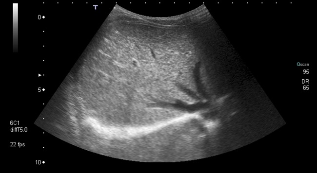 Figura 1. Ecografía hepática: hígado homogéneo de tamaño normal sin lesiones focales. Ausencia de vesícula. No dilatación de la vía biliar intra- y extrahepática