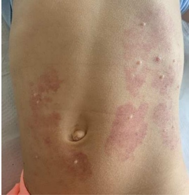 Figura 1. Molusco contagioso asociado a lesiones eritematosas difusas con bordes irregulares en abdomen