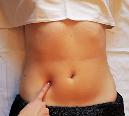 Figura 1. Signo de Carnett. Se comprime el punto de máximo dolor y se solicita al paciente que se incorpore desde el decúbito, objetivándose un aumento excesivo del dolor, en comparación con el lado contralateral