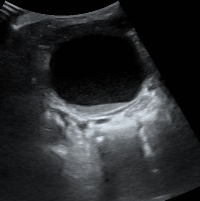 Figura 2. Distensión vesical con nivel líquido-sedimento y discreto engrosamiento de pared