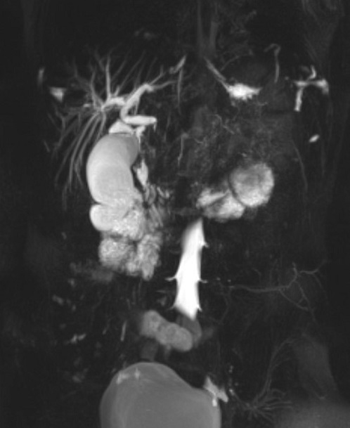 Fig. 1. Colangiorresonancia magnética pancreática con secuencias potenciadas en T2 y difusión. Afectación inflamatoria difusa de páncreas con mayor inflamación de cabeza pancreática condicionando compresión extrínseca sobre colédoco intrapancreático que se encuentra totalmente obliterado