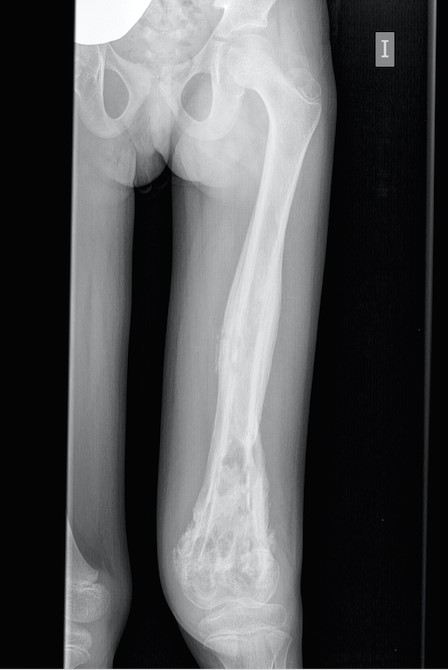 Figura 1. Radiografía de extremidad inferior izquierda. En tercio medio y distal de fémur se observan áreas líticas y reacción perióstica adyacente, junto con signos indirectos de derrame articular
