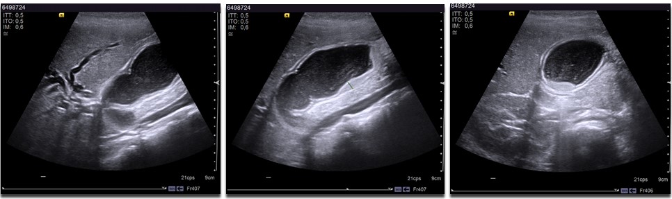 Figura 1. Ecografía con hallazgos de vesícula biliar distendida y barro en su interior.