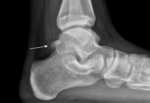 Figura 1. Os trigonum, persistencia del centro de osificación lateral en la cara posterior del astrágalo