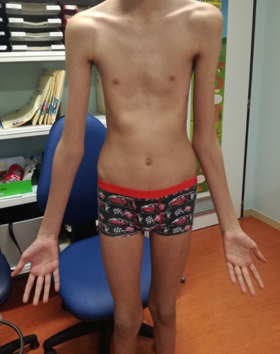 Figura 1. Imagen en la que se observa el fenotipo tan característico de nuestro paciente